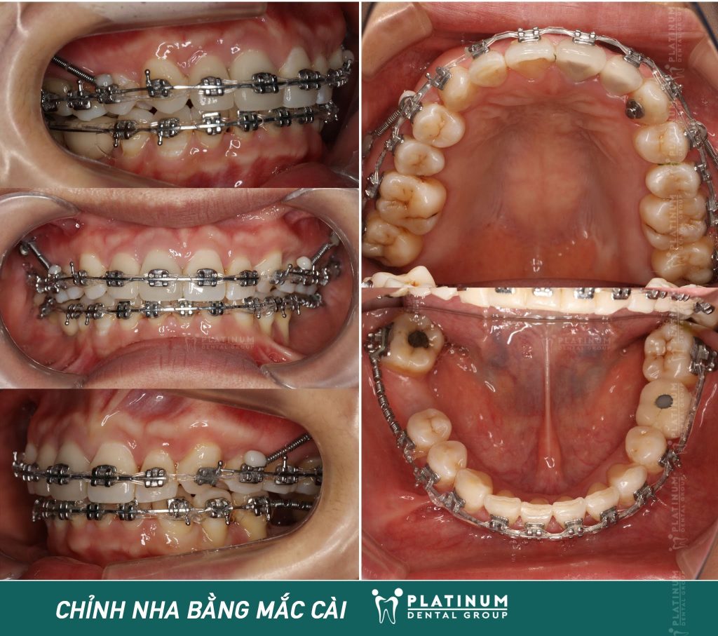 Lệch đường giữa