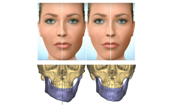 Lệch hàm sang trái hoặc phải