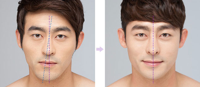 Mặt lệch, cằm lệch
