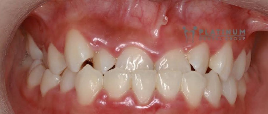 Một số dấu hiệu giúp nhận biết sớm khớp cắn ngược ở trẻ nhỏ