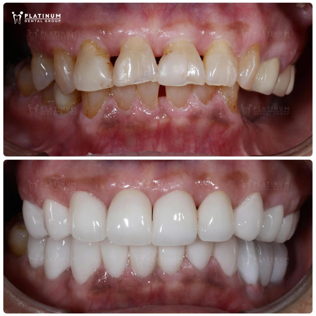 Artistry in Restoration: Natural Beauty, Functional Strength