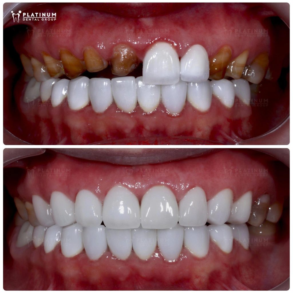 Redo 8 upper veneers at Platinum Dental and regular maintenance for lower teeth
