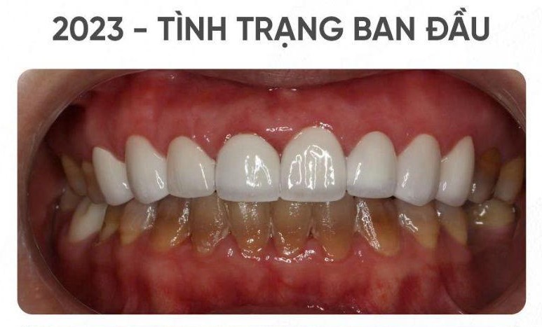 Before: Upper veneers done at another clinic, Severe discoloration on lower teeth
