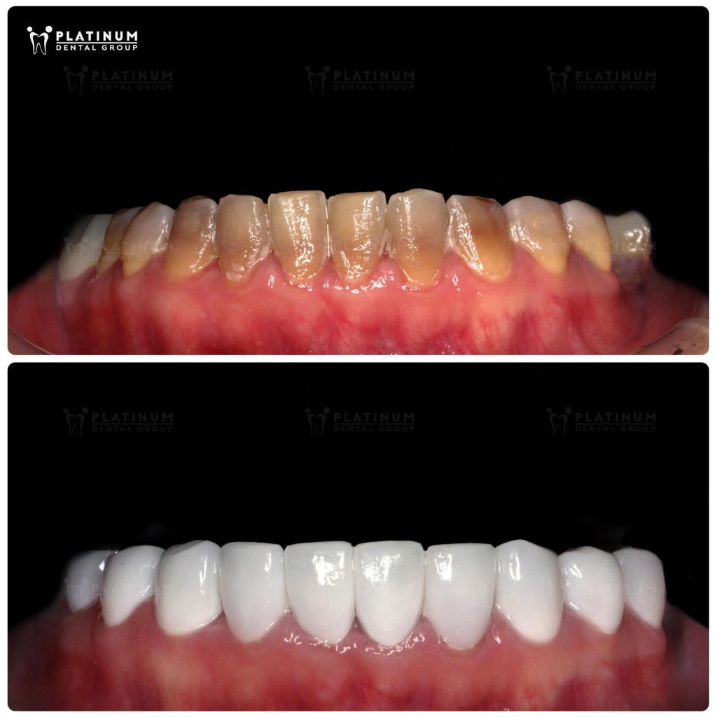 And 10 veneers done at Platinum Dental in 2023