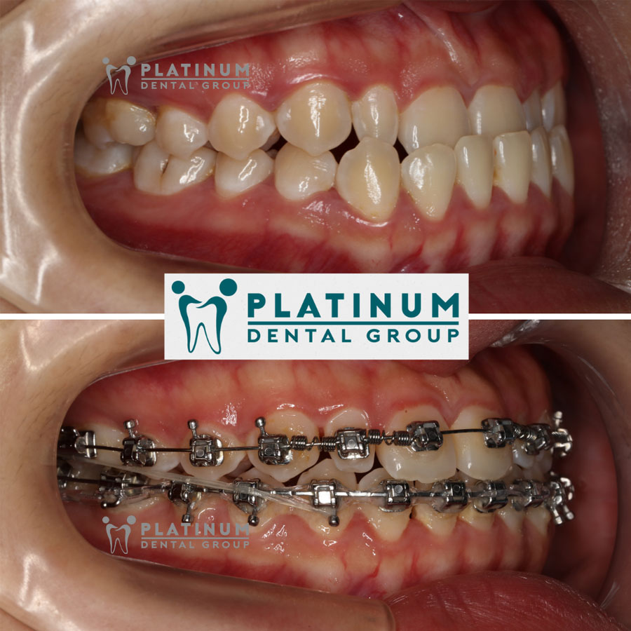 Những câu hỏi phổ biến khi bắt đầu đeo thun trong quá trình niềng răng