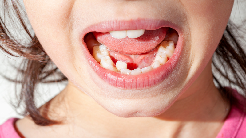 Những nguyên nhân khiến hàm bị lệch