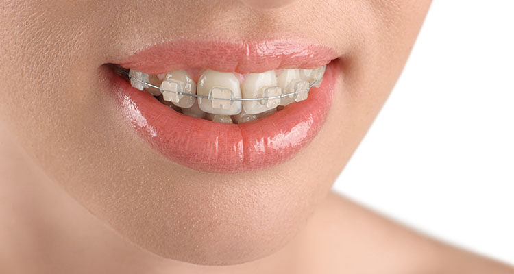 Niềng răng 1 hàm có thể thực hiện, nhưng không phải là lựa chọn phổ biến trong chỉnh nha