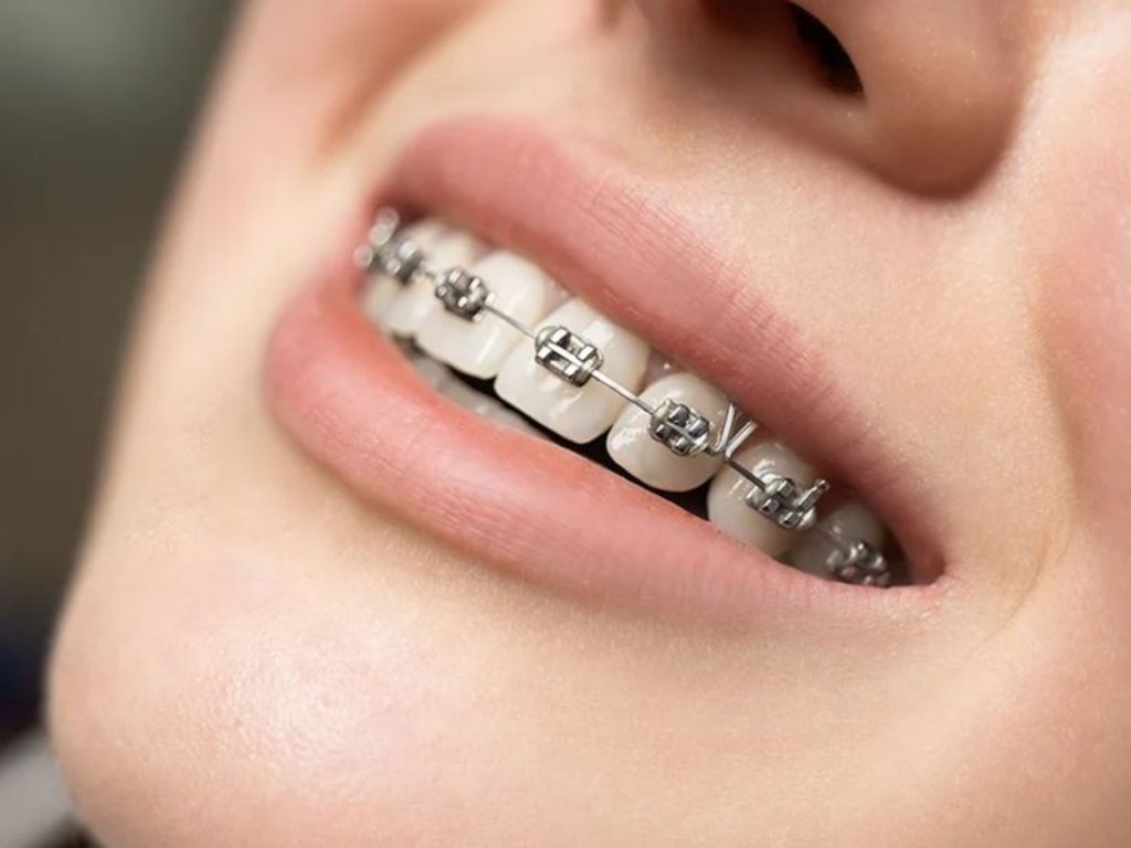 Niềng răng 1 hàm là phương pháp chỉnh nha chỉ áp dụng khí cụ niềng răng trên một cung hàm