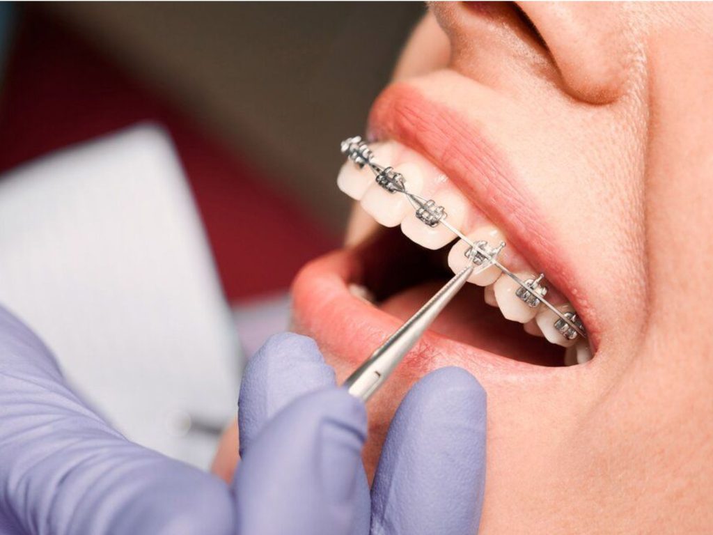 Bác sĩ tiến hành gắn khí cụ chỉnh nha