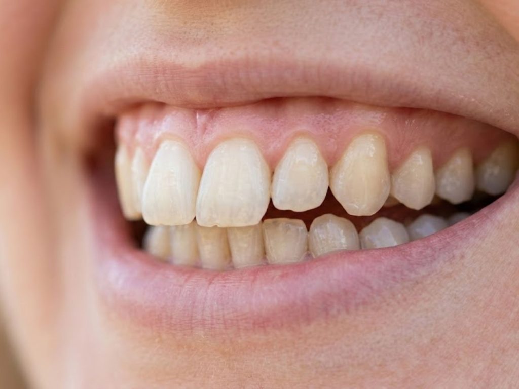 Niềng răng 1 hàm có thể được áp dụng để điều chỉnh vị trí của răng cửa có xu hướng chìa nhẹ ra phía trước