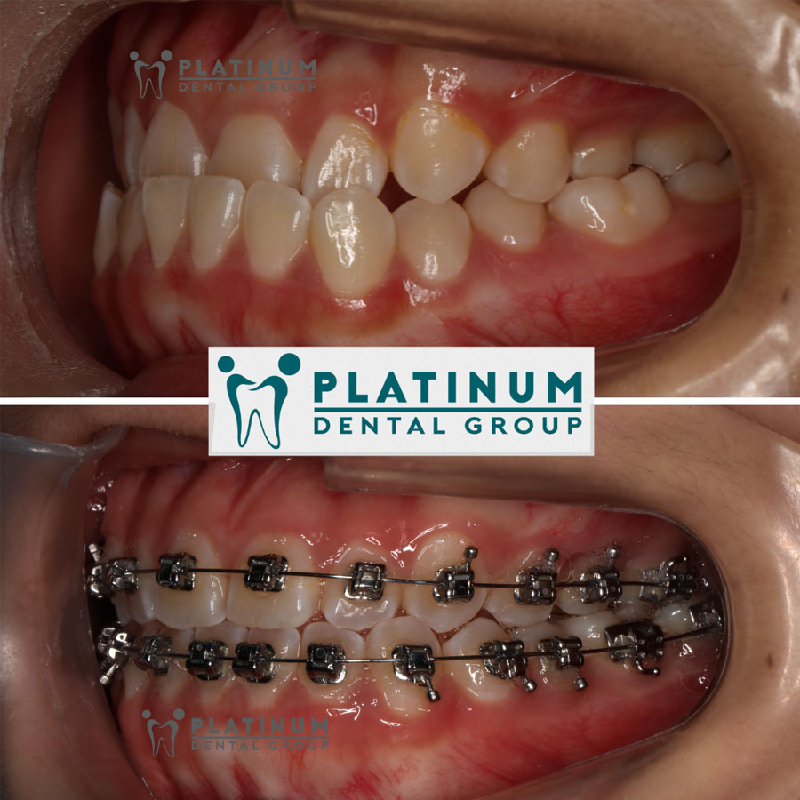 Đối với trường hợp sai khớp cắn, bệnh nhân không nên niềng răng 1 hàm