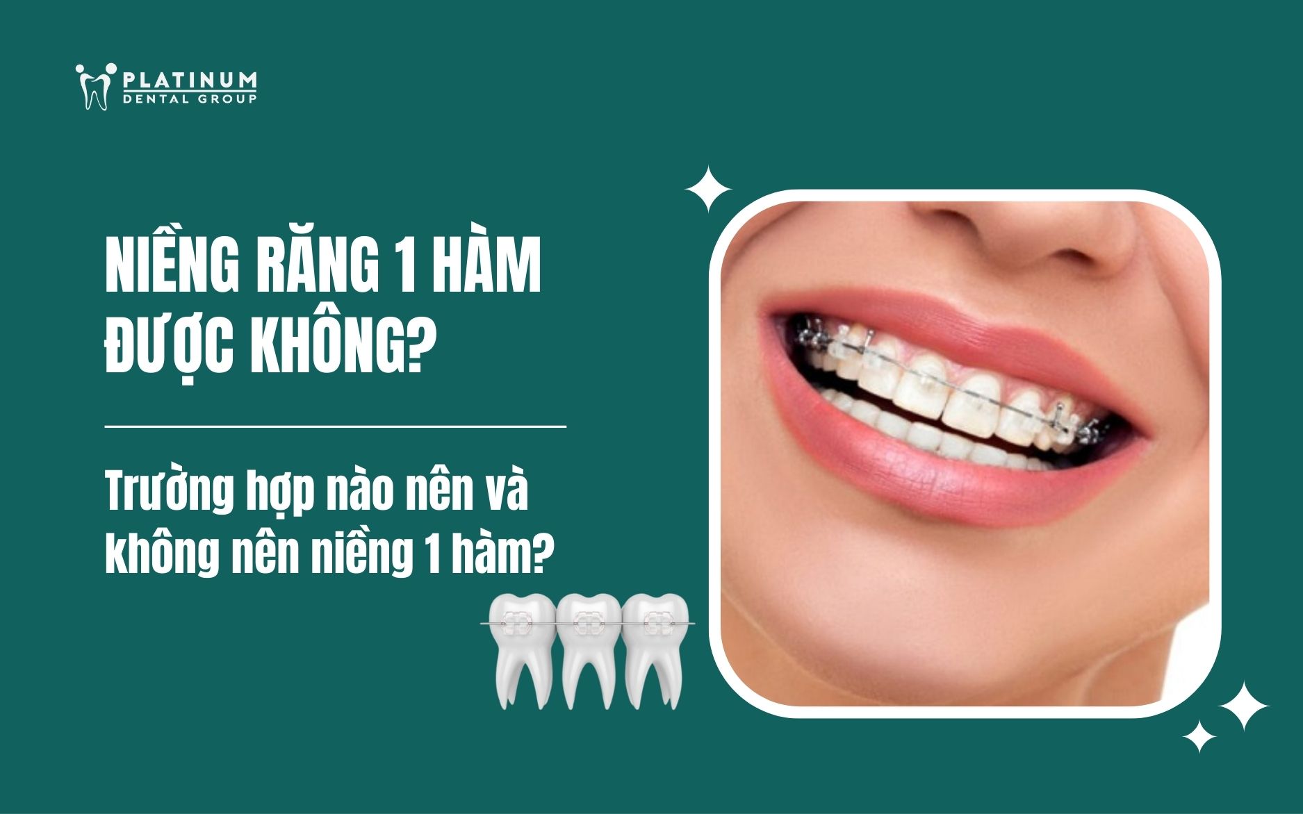 niềng răng 1 hàm được không