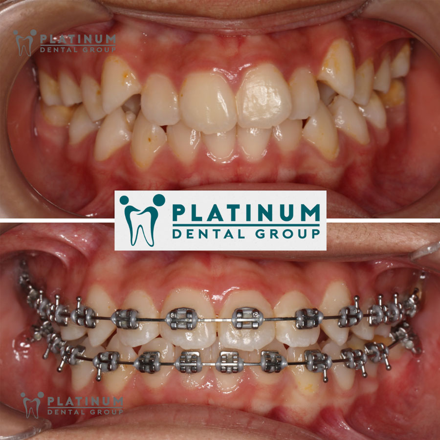 Niềng răng mắc cài kim loại