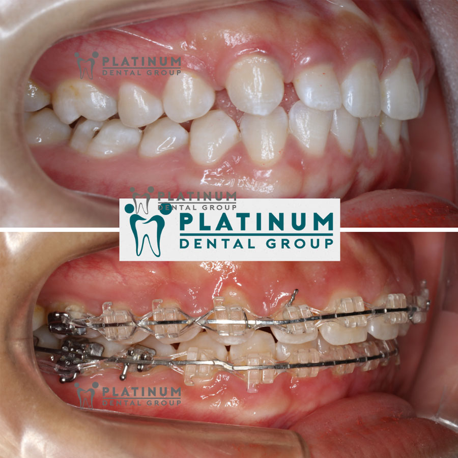 Niềng răng mắc cài sứ