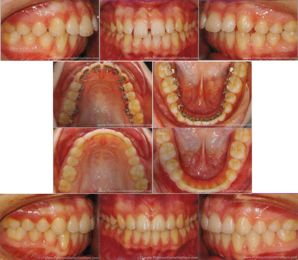 Niềng răng mặt trong