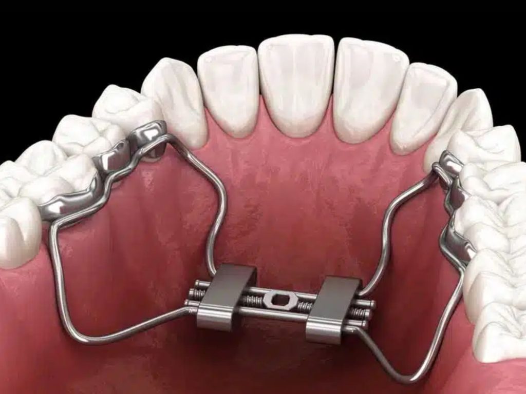 Thời gian nong hàm có thể khác nhau ở mỗi người