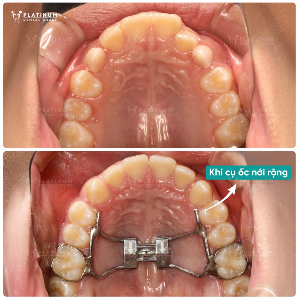 Nong hàm giúp tạo thêm khoảng trống trên cung hàm