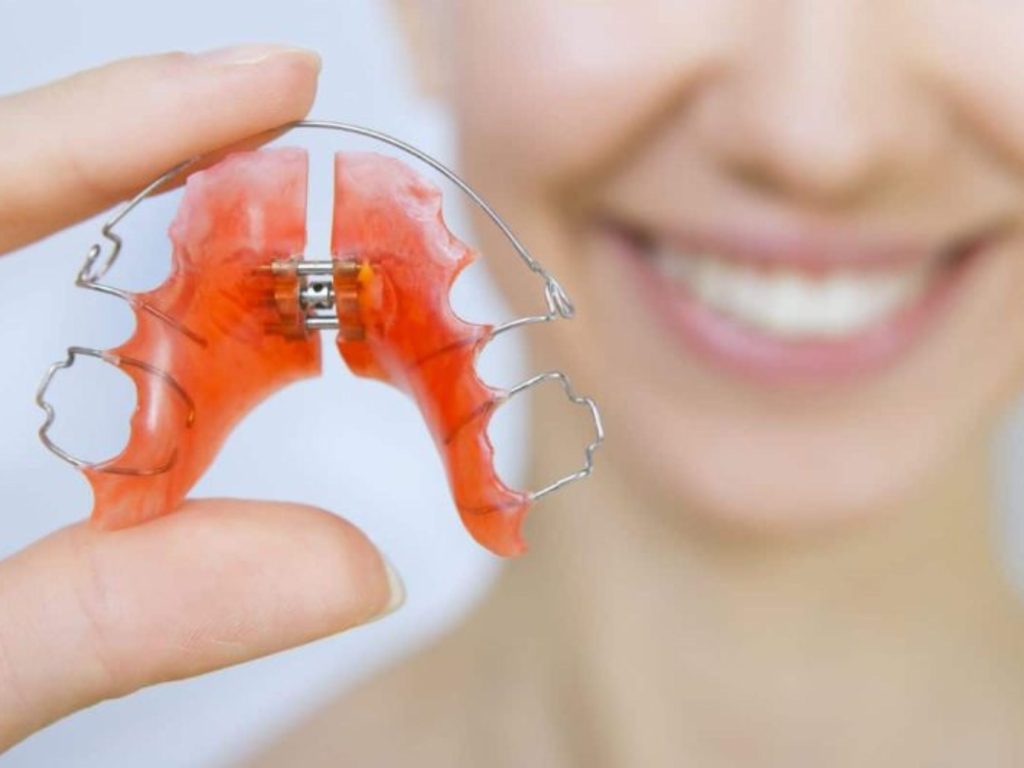 Khí cụ nong hàm tháo lắp được thiết kế để người bệnh có thể tháo ra khi ăn uống hoặc vệ sinh răng miệng