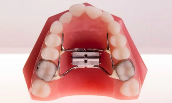 Nong hàm giúp tạo không gian cho răng, hỗ trợ hoạt động niềng răng hiệu quả