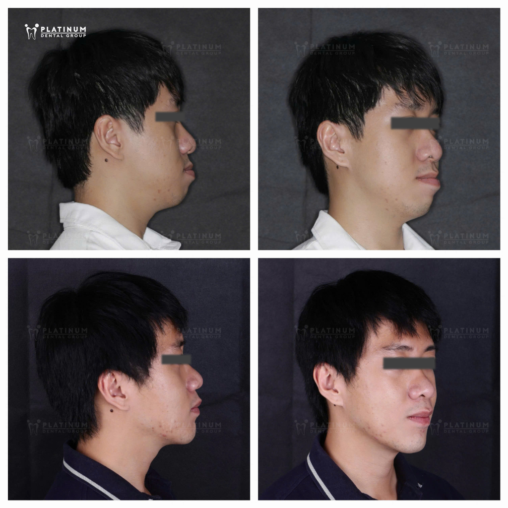 Phẫu thuật chỉnh hàm