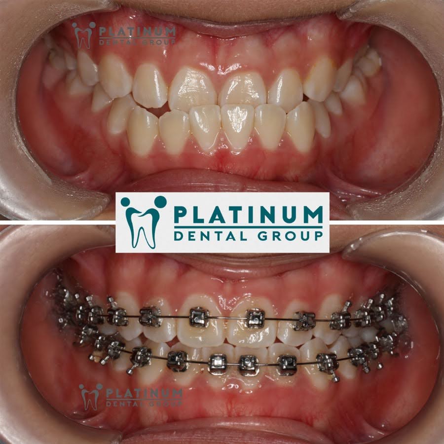 Chữa lệch hàm bằng niềng răng (trường hợp do răng)