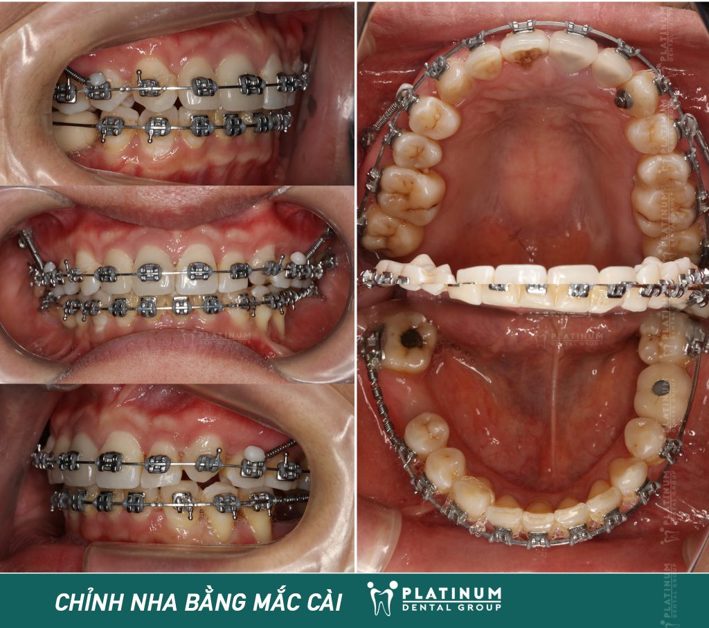 Răng bắt đầu di chuyển rõ rệt