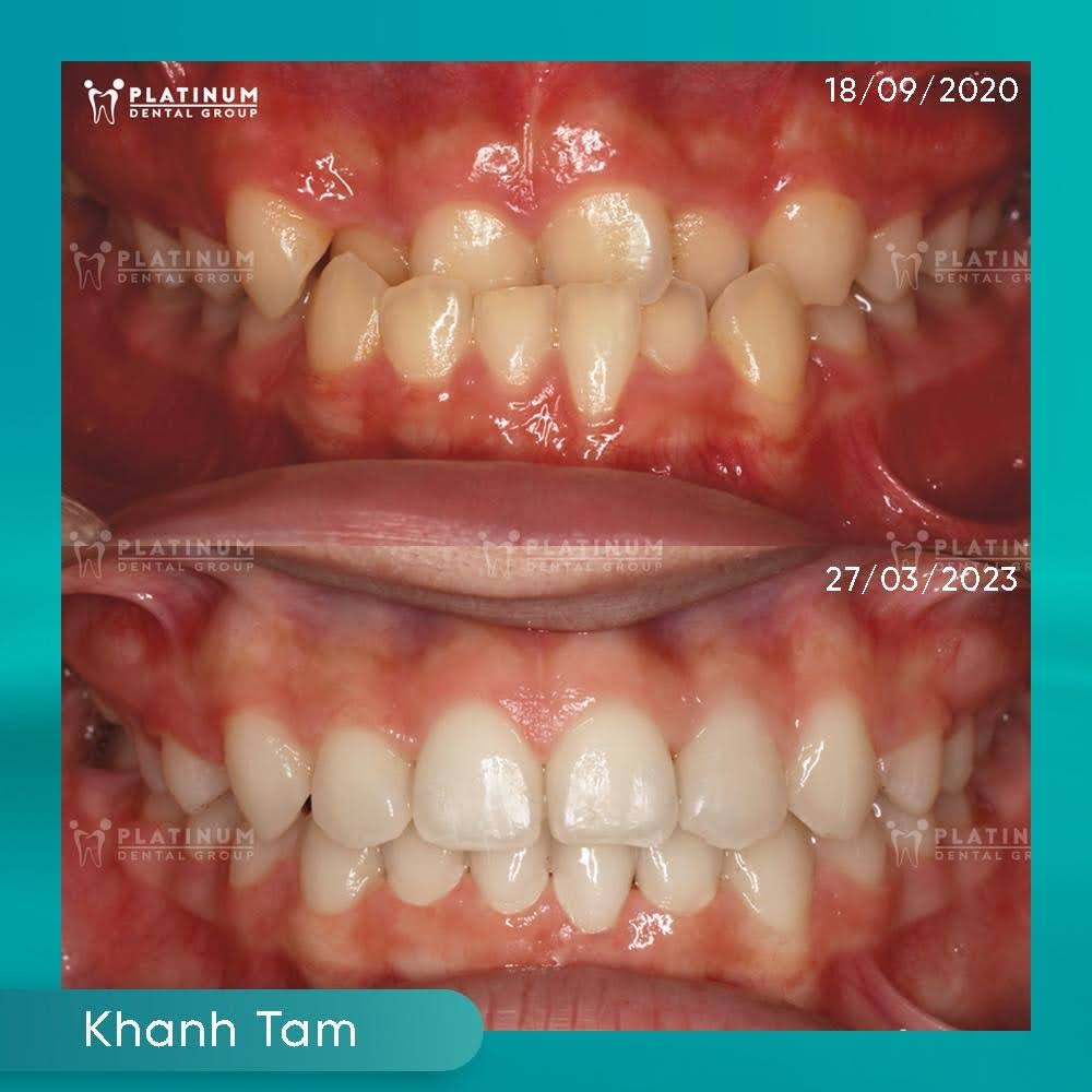 So sánh khớp cắn trước và sau chỉnh nha, cho thấy sự cải thiện rõ rệt về vị trí răng và tương quan hai hàm