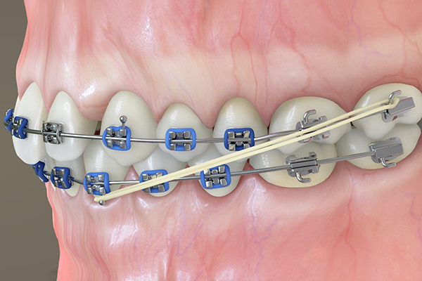Thun chỉnh nha được móc vào mắc cài để tạo lực kéo giữa các răng trong quá trình niềng