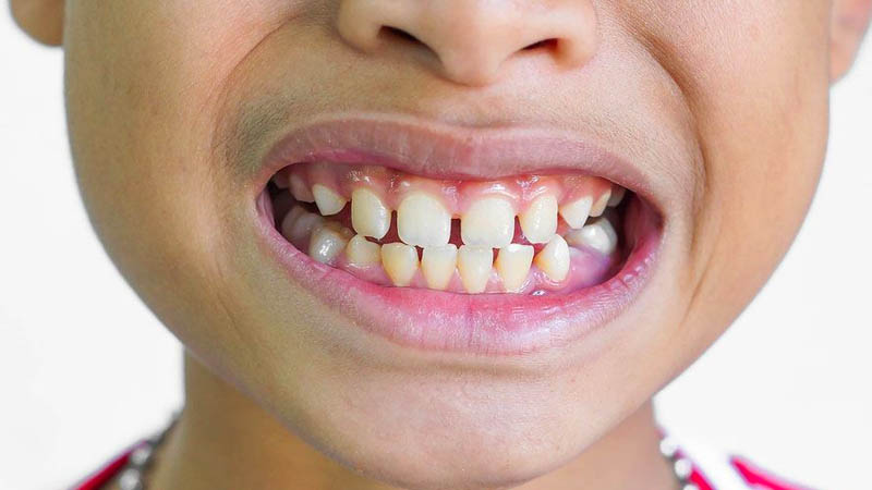 Tình trạng khớp cắn ngược ở trẻ