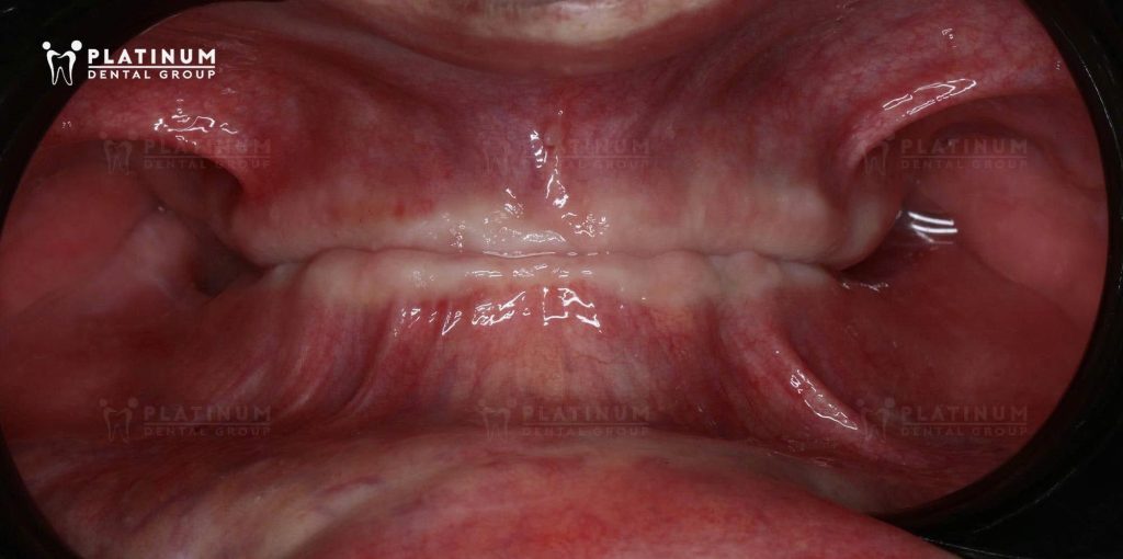 total tooth loss