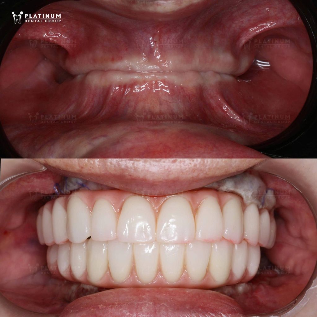Implant toàn hàm: Một hành trình cần kế hoạch đúng ngay từ đầu