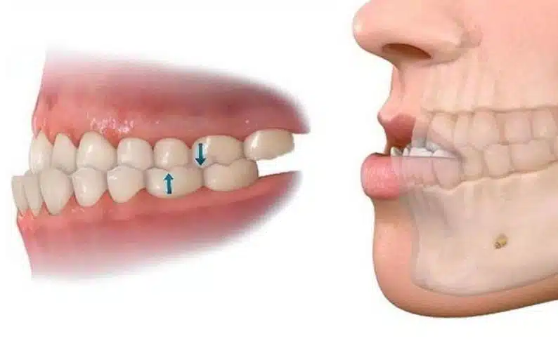 Các vấn đề do hàm lệch gây ra: mất thẩm mỹ, khó nhai, ảnh hưởng tiêu hóa và phát âm