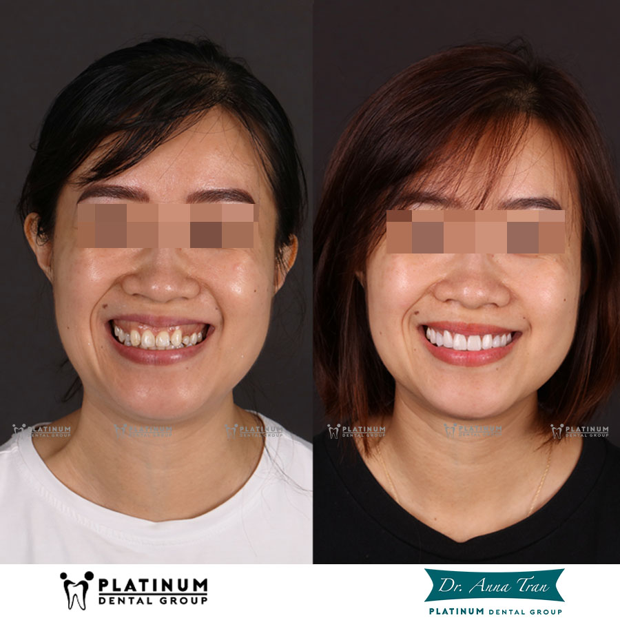 Cười hở lợi khiến nụ cười kém hài hòa