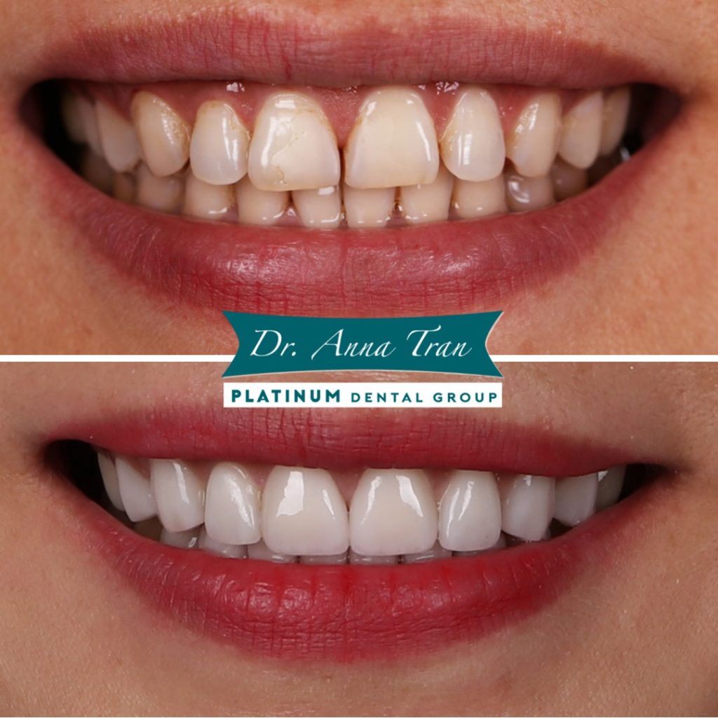 Trường hợp cắt nướu bằng bằng laser và dán sứ thẩm mỹ Veneer tại Platinum Dental Group