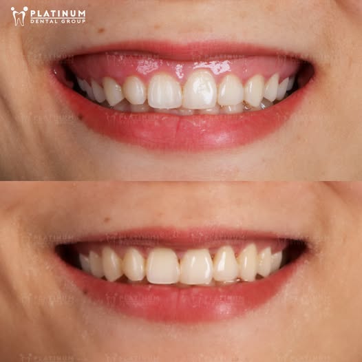 Trường hợp cắt nướu bằng laser hiện đại không đau, không chảy máu tại Platinum Dental Group