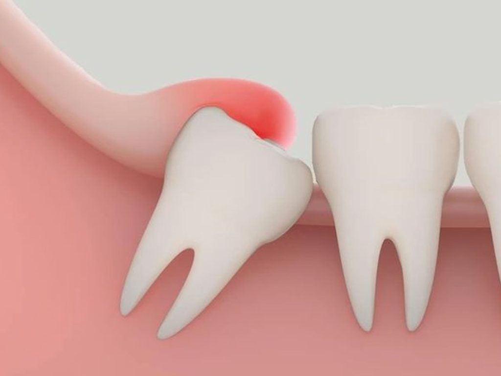 Lợi trùm răng khôn là tình trạng phần nướu phát triển phủ lên một phần hoặc toàn bộ bề mặt răng số 8