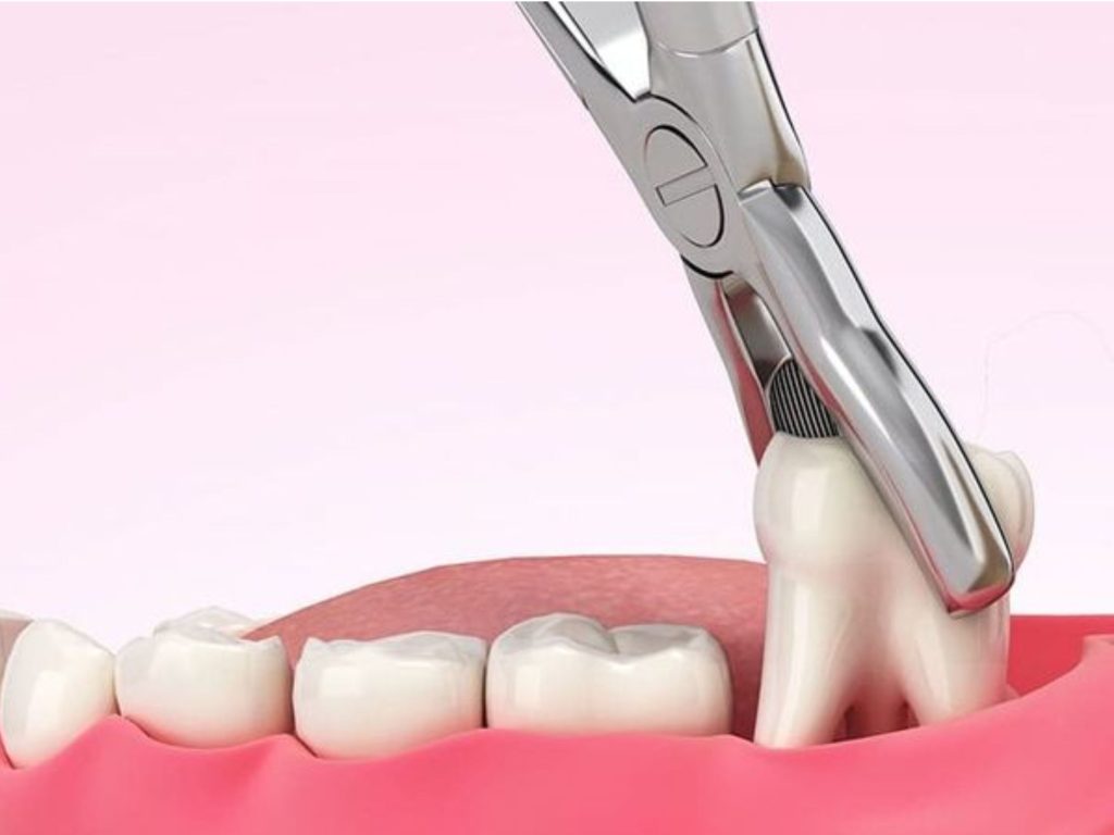 Bác sĩ thường ưu tiên chỉ định nhổ răng khôn thay vì chỉ cắt lợi