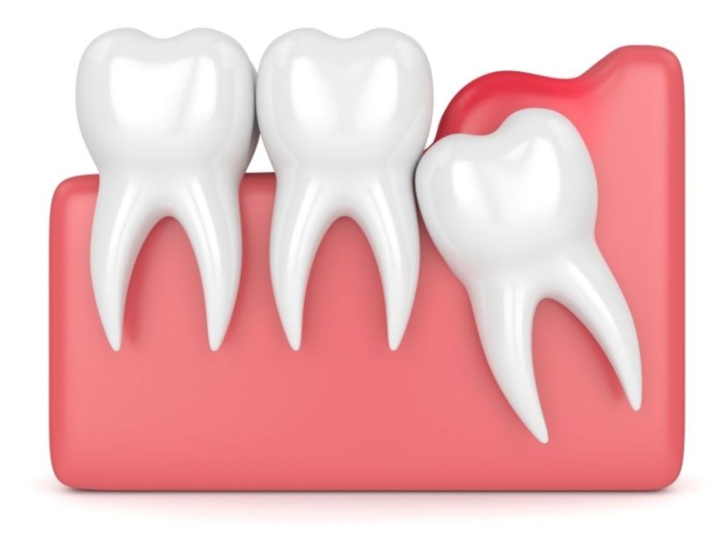 Tình trạng mọc của răng khôn ảnh hưởng trực tiếp đến chi phí điều trị