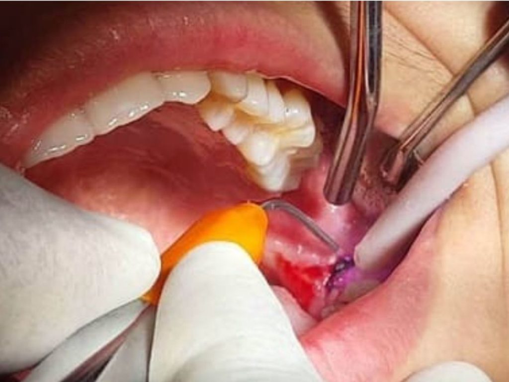 Bác sĩ sẽ gây tê cục bộ tại vùng răng khôn nên qua trình cắt lợi trùm không đau