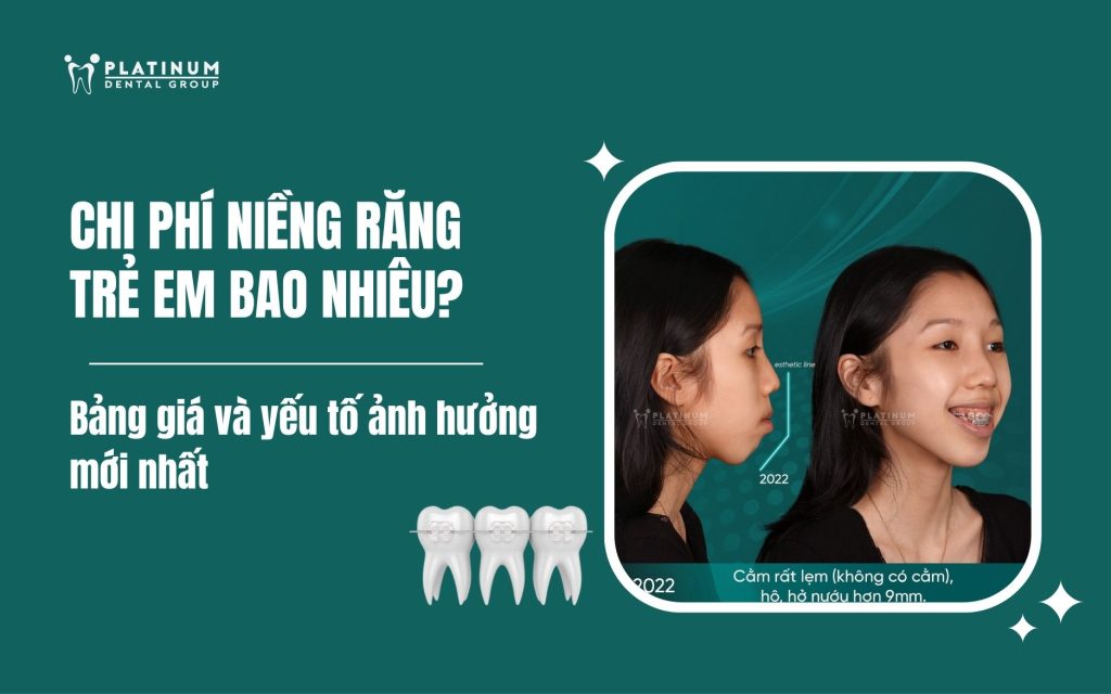 Chi phí niềng răng trẻ em