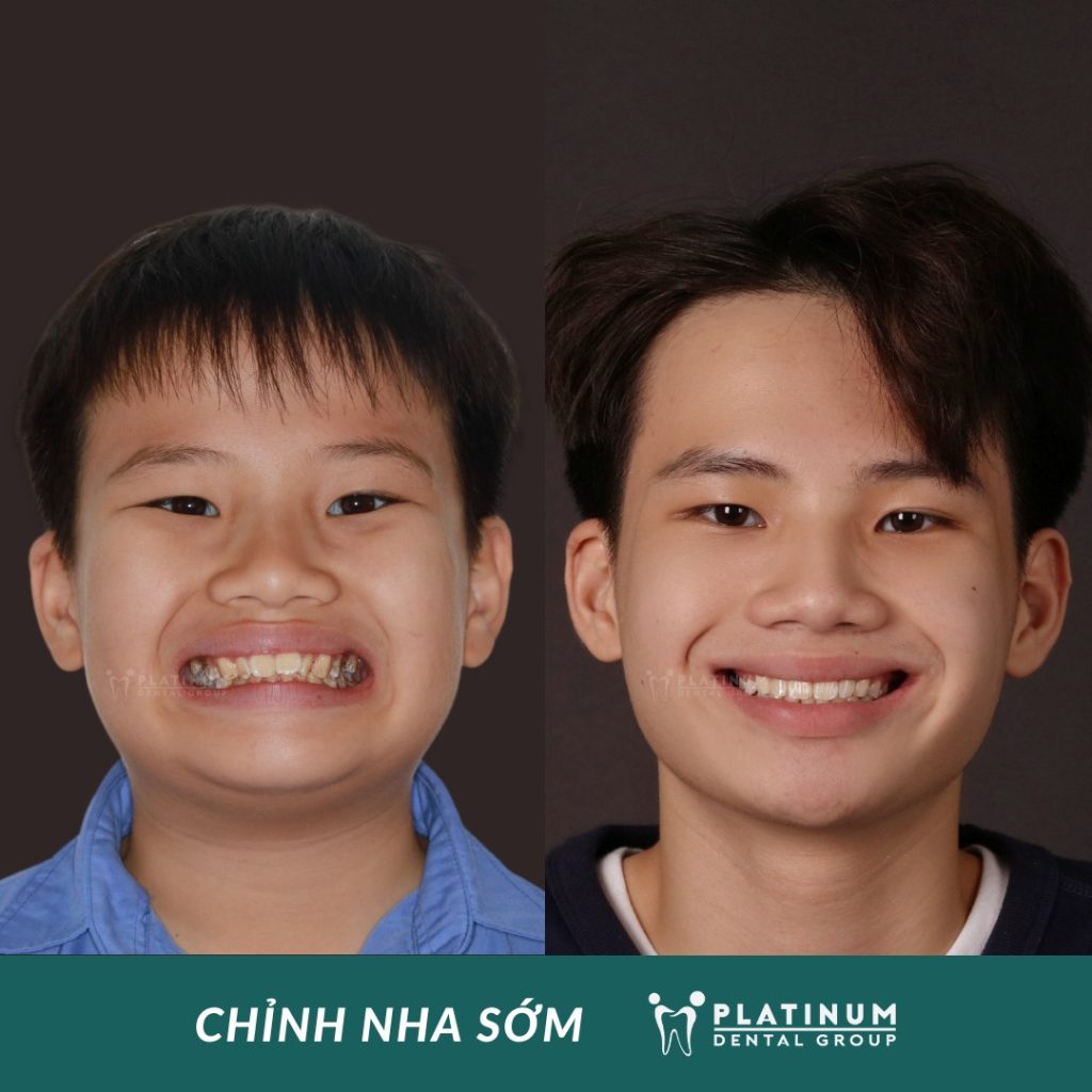 Chi phí niềng răng trẻ em bao nhiêu? Bảng giá và yếu tố ảnh hưởng mới nhất 2026 4 Niềng răng sớm cho trẻ giúp cải thiện thẩm mỹ nụ cười, hỗ trợ sự phát triển của xương hàm