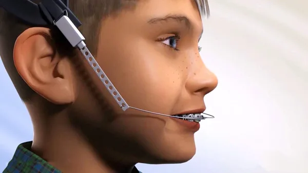 Headgear là khí cụ chỉnh nha tháo lắp ngoài mặt