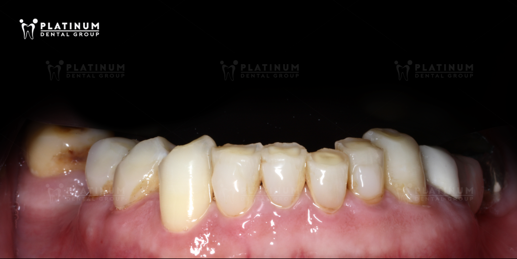 KHẮC PHỤC TÌNH TRẠNG RĂNG MÒN MẶT CẮN VÀ MẤT NHIỀU RĂNG BẰNG GIẢI PHÁP KẾT HỢP 12 VENEER & 3 IMPLANT 1 NHỮNG TRIỆU CHỨNG NGUY HIỂM KHI BỊ MÒN MẶT CẮN