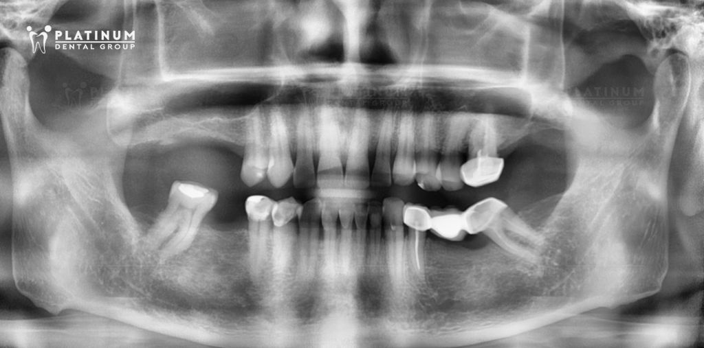 KHẮC PHỤC TÌNH TRẠNG RĂNG MÒN MẶT CẮN VÀ MẤT NHIỀU RĂNG BẰNG GIẢI PHÁP KẾT HỢP 12 VENEER & 3 IMPLANT 2 TRIỆU CHỨNG NGUY HIỂM KHI BỊ MÒN MẶT CẮN VÀ MẤT RĂNG LÂU NĂM