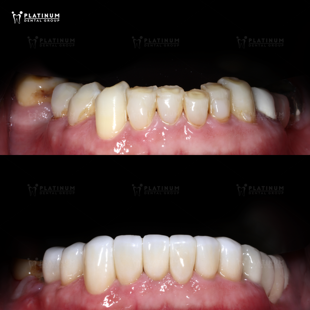 KHẮC PHỤC TÌNH TRẠNG RĂNG MÒN MẶT CẮN VÀ MẤT NHIỀU RĂNG BẰNG GIẢI PHÁP KẾT HỢP 12 VENEER & 3 IMPLANT 3 KHÔI PHỤC HÀM RĂNG ĐỀU ĐẶN, ĂN NHAI TỰ NHIÊN