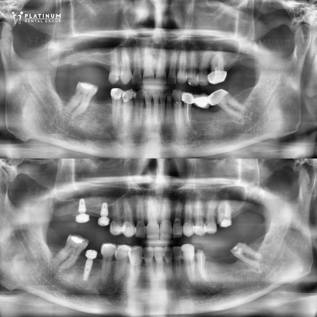 KHẮC PHỤC TÌNH TRẠNG RĂNG MÒN MẶT CẮN VÀ MẤT NHIỀU RĂNG BẰNG GIẢI PHÁP KẾT HỢP 12 VENEER & 3 IMPLANT 5 Thực hiện 3 trụ Implant vùng răng trong bên phải