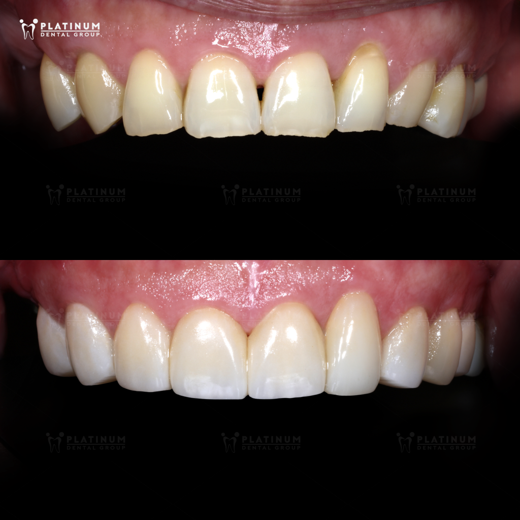 KHẮC PHỤC TÌNH TRẠNG RĂNG MÒN MẶT CẮN VÀ MẤT NHIỀU RĂNG BẰNG GIẢI PHÁP KẾT HỢP 12 VENEER & 3 IMPLANT