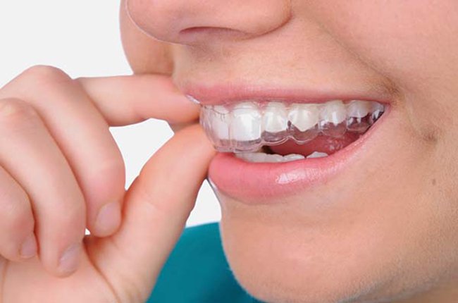 Khay niềng trong suốt linh hoạt, thẩm mỹ cao, phù hợp với mất răng không quá phức tạp