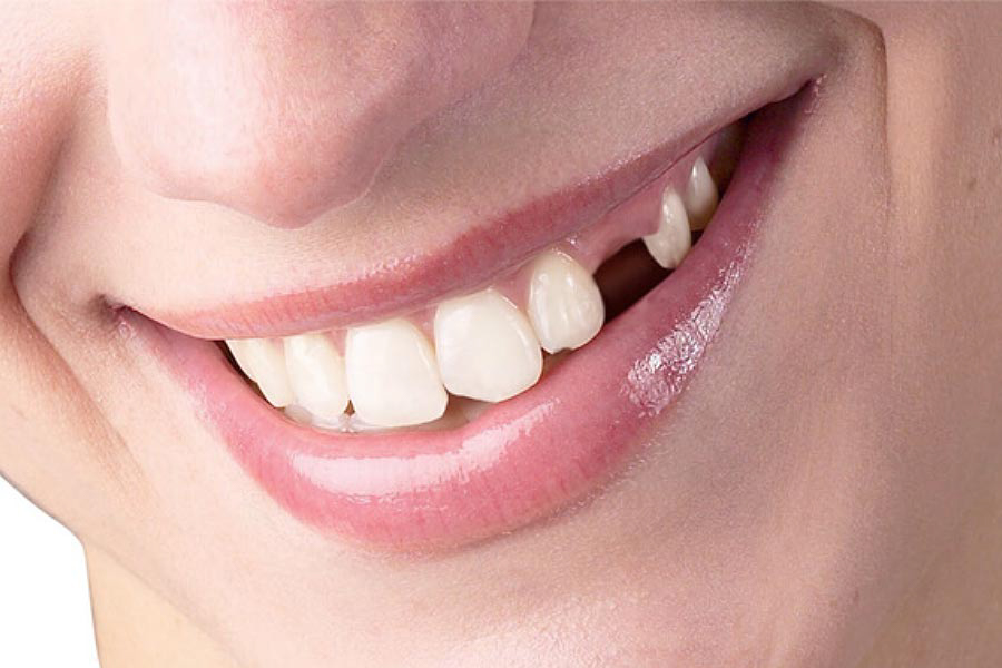 Khoảng trống răng mất có thể được điều chỉnh nhờ niềng răng, giúp phục hồi chức năng và thẩm mỹ hàm răng