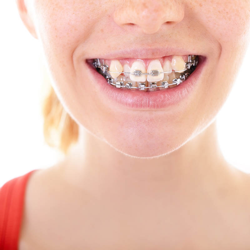 Giải đáp: Niềng răng có mất răng khểnh không? 4 Nhổ răng chỉ áp dụng khi cung hàm quá chật hoặc răng khểnh lệch nặng